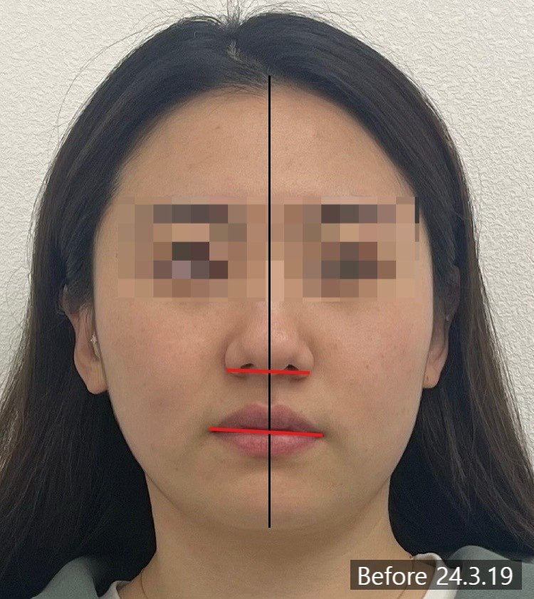 치료 전 정면 사진에 얼굴 정중선과 눈·입꼬리 수평선을 얹어 좌우 차이를 표시한 사진 — 보정 없는 원본