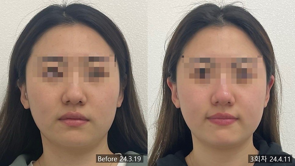 안면비대칭 교정 3회차 정면 전후 비교 — 동일 인물·동일 조건에서 촬영한 보정 없는 원본