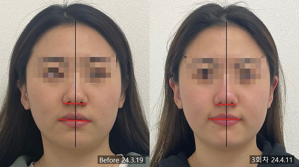 같은 3회차 전후 사진 위에 정중선을 얹어 좌우 면적 차이를 비교한 사진 — 보정 없는 원본