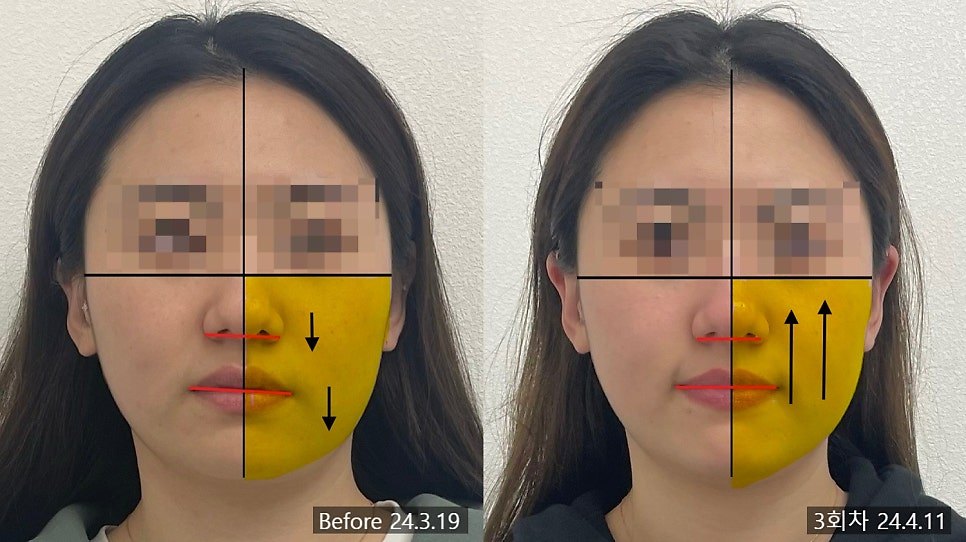 힘이 약한 쪽 얼굴을 노란색으로 칠하고 방향 화살표를 표시한 3회차 전후 비교 — 보정 없는 원본