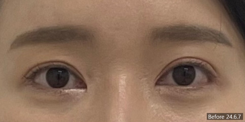 안면비대칭 시술 기록 1 — 동일 인물·동일 조건에서 촬영한 보정 없는 원본 사진