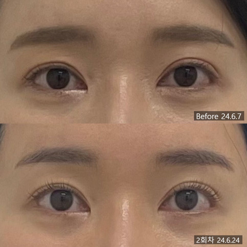 안면비대칭 시술 기록 3 — 동일 인물·동일 조건에서 촬영한 보정 없는 원본 사진