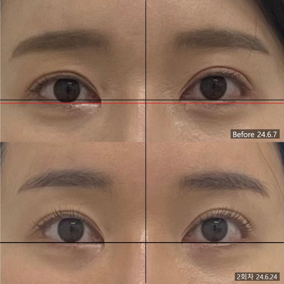 안면비대칭 시술 기록 4 — 동일 인물·동일 조건에서 촬영한 보정 없는 원본 사진