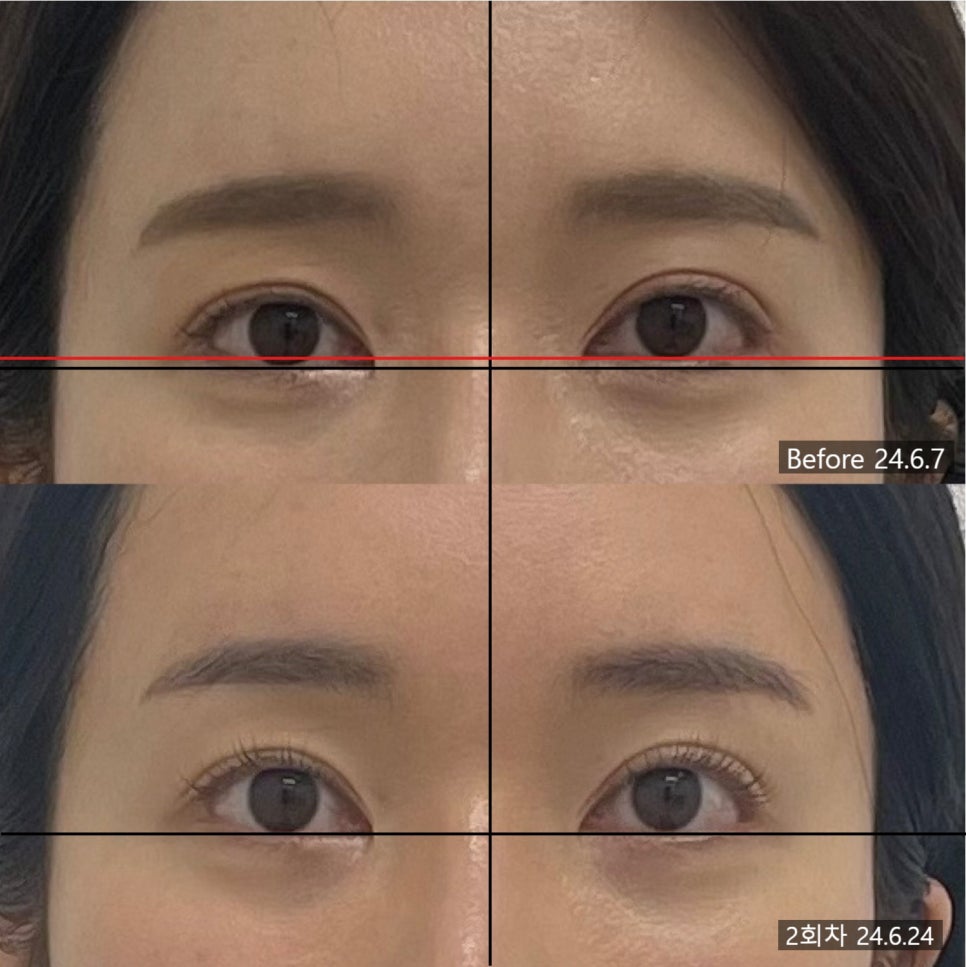 안면비대칭 시술 기록 5 — 동일 인물·동일 조건에서 촬영한 보정 없는 원본 사진
