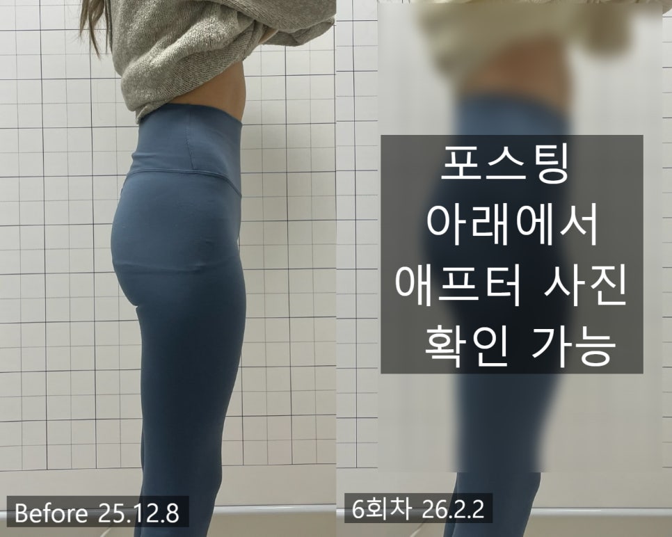 애플힙 시술 기록 1 — 동일 인물·동일 조건에서 촬영한 보정 없는 원본 사진