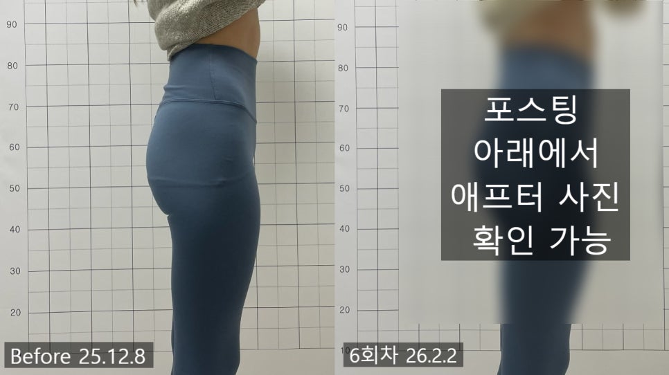 애플힙 시술 기록 2 — 동일 인물·동일 조건에서 촬영한 보정 없는 원본 사진