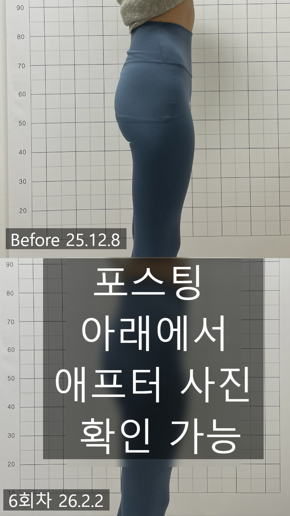 애플힙 시술 기록 3 — 동일 인물·동일 조건에서 촬영한 보정 없는 원본 사진