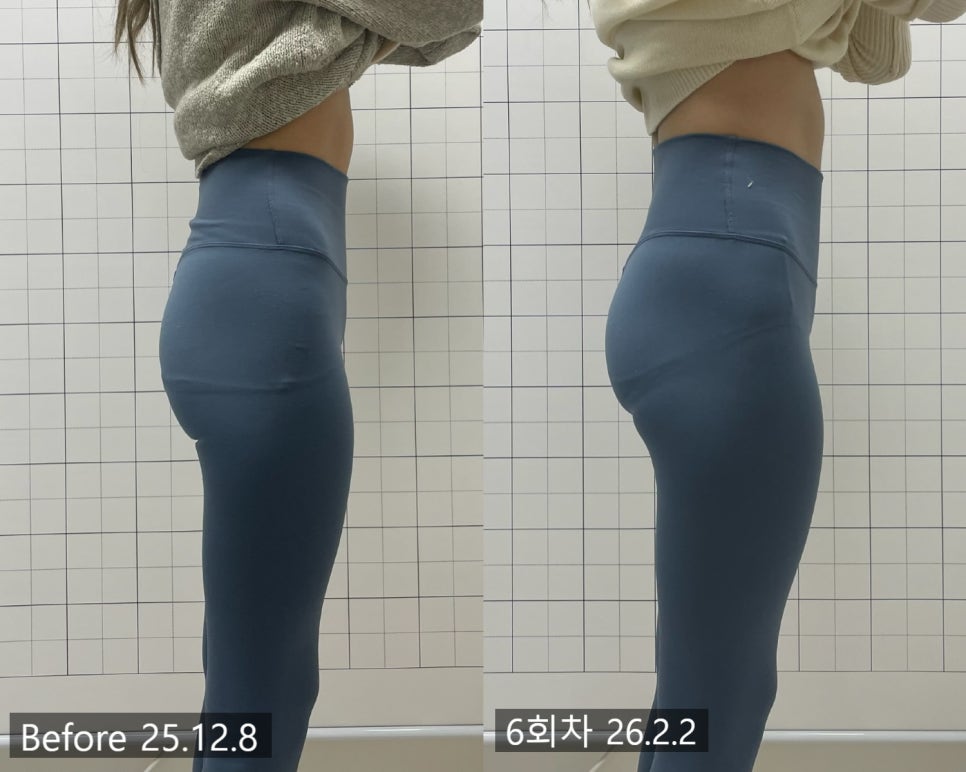 애플힙 시술 기록 8 — 동일 인물·동일 조건에서 촬영한 보정 없는 원본 사진