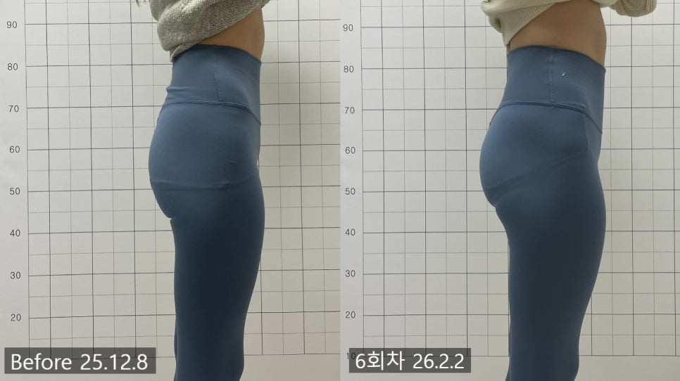 애플힙 시술 기록 9 — 동일 인물·동일 조건에서 촬영한 보정 없는 원본 사진