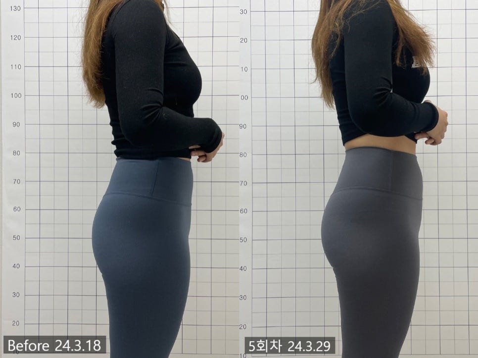 애플힙 자극침 5회차 측면 전후 비교 — 동일 인물·동일 조건에서 촬영한 보정 없는 원본