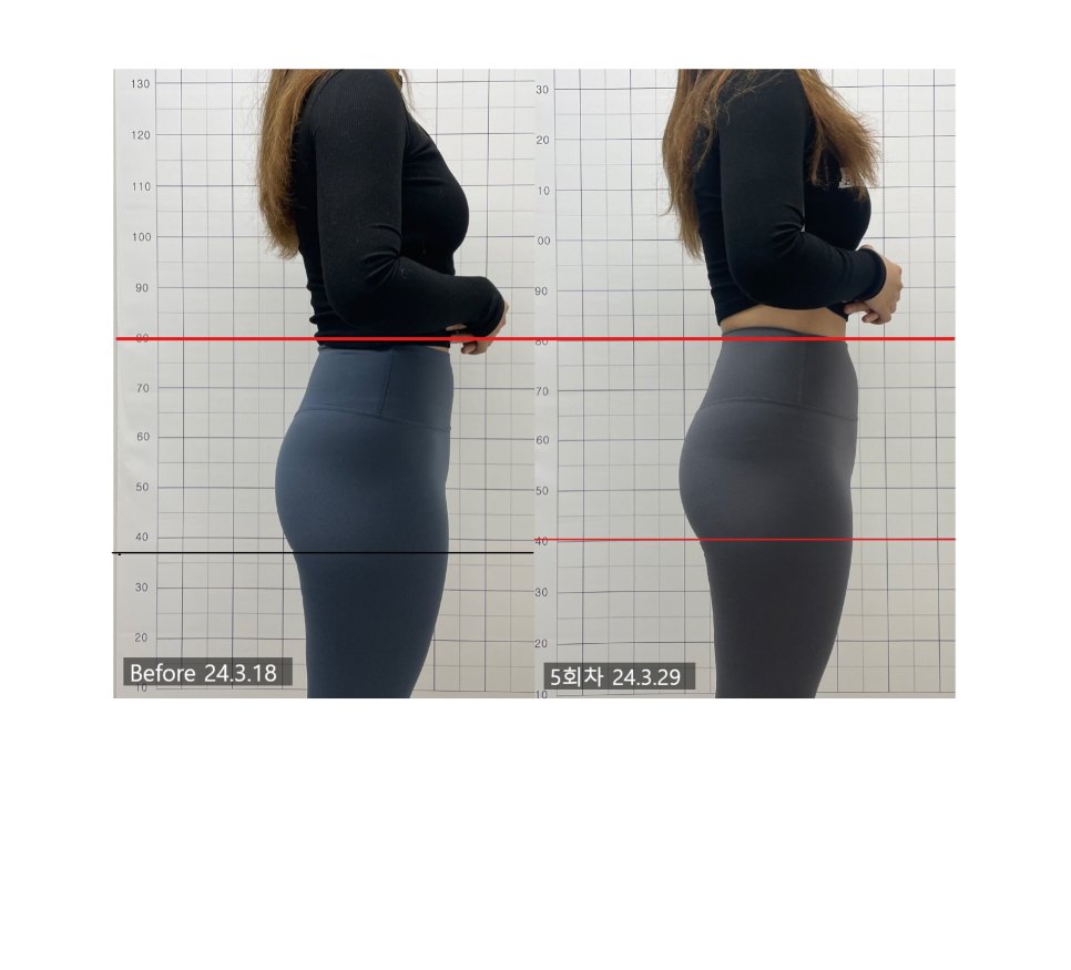 기준선 간격 변화를 확대해 표시한 5회차 전후 비교 — 보정 없는 원본
