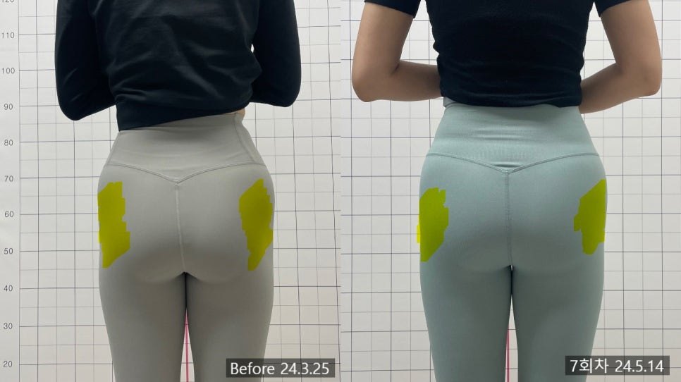 중둔근 구역을 노란색으로 칠해 표시한 7회차 전후 비교 — 보정 없는 원본