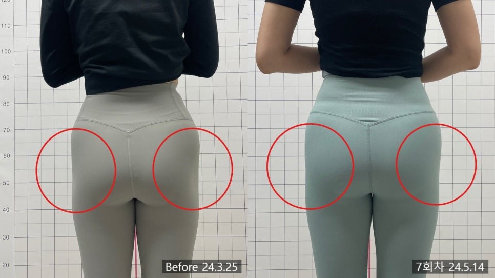옆엉덩이 힙딥 구역을 원으로 표시해 채워진 정도를 비교한 7회차 전후 — 보정 없는 원본