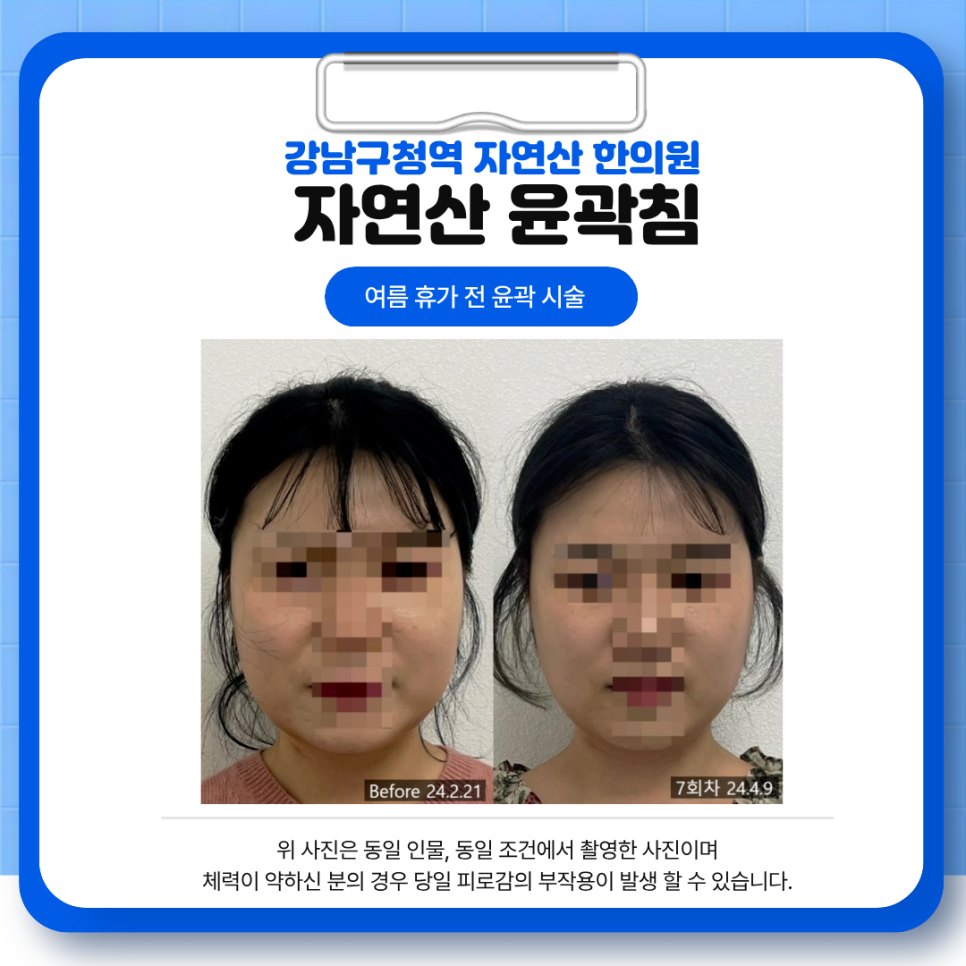 자연산 윤곽침 7회차 정면 전후 비교 — 동일 인물·동일 조건에서 촬영한 보정 없는 원본