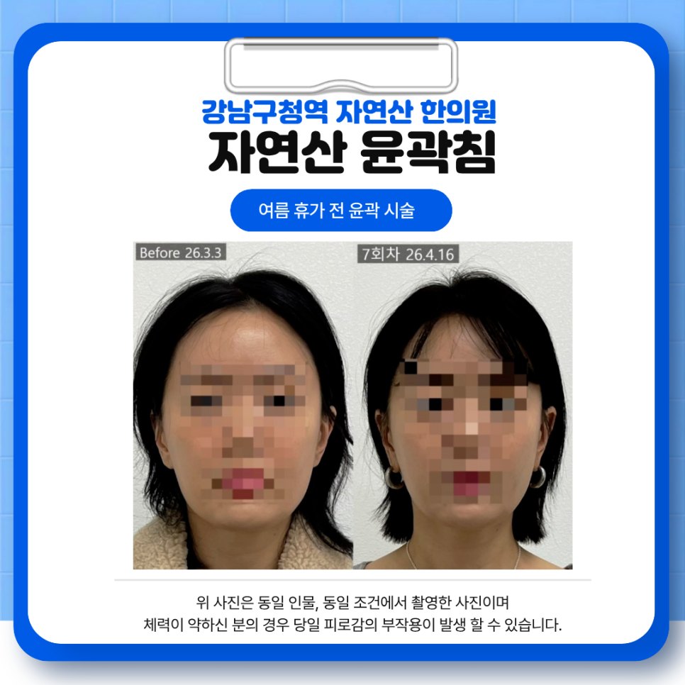 자연산 윤곽침 7회차 정면 전후 비교 두 번째 기록 — 보정 없는 원본