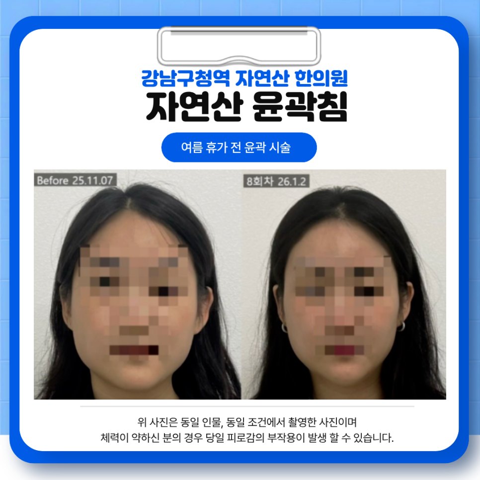자연산 윤곽침 8회차 정면 전후 비교 — 보정 없는 원본