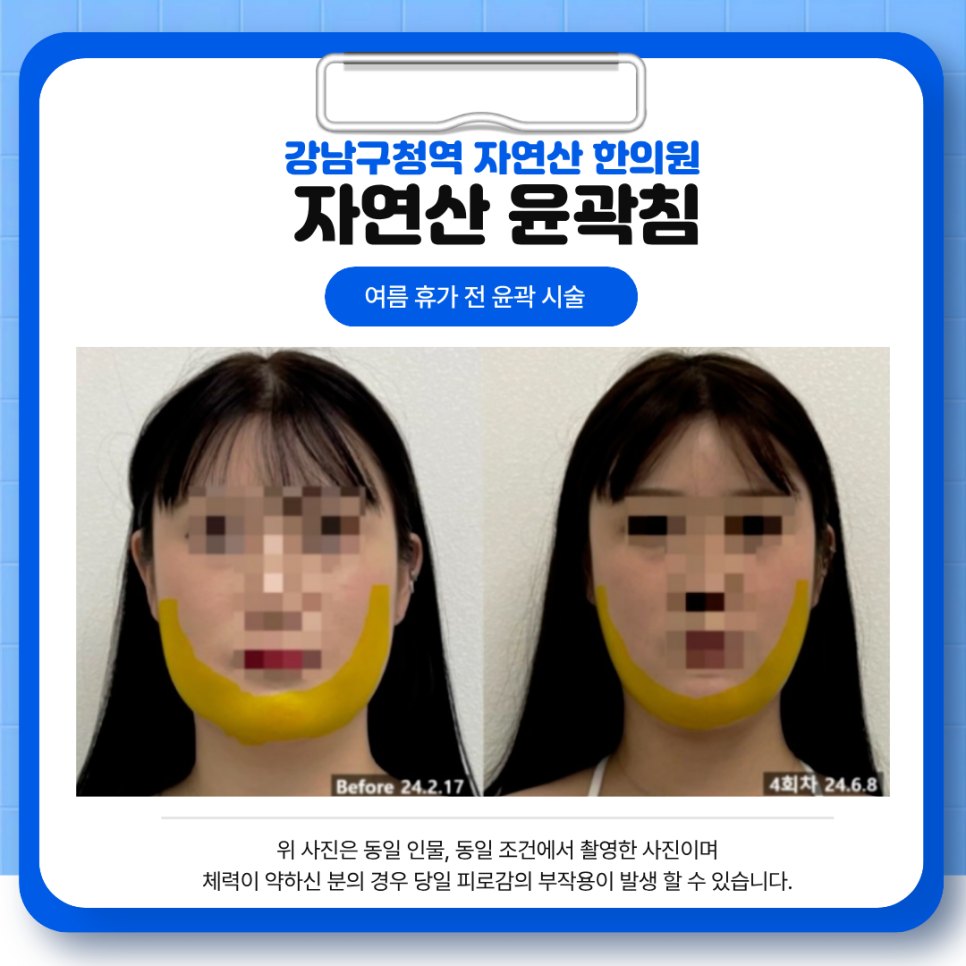 턱선 영역을 표시한 4회차 정면 전후 비교 — 보정 없는 원본