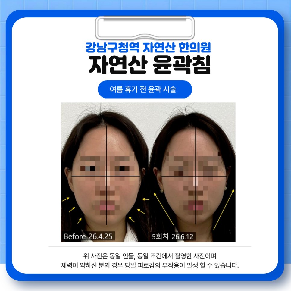 정중선과 좌우 폭 기준선을 얹은 5회차 정면 전후 비교 — 보정 없는 원본