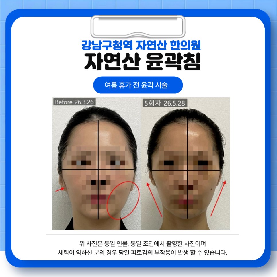 턱선 곡선을 표시한 5회차 정면 전후 비교 — 보정 없는 원본