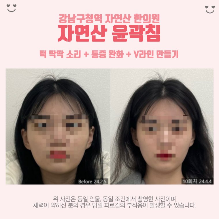 jaw-clicking-sound 치료 사례 2 — 시술 전후 비교