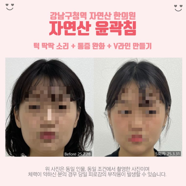 jaw-clicking-sound 치료 사례 3 — 시술 전후 비교