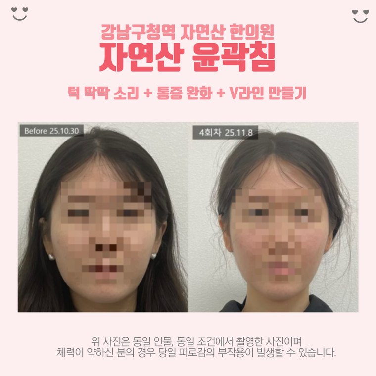 jaw-clicking-sound 치료 사례 4 — 시술 전후 비교