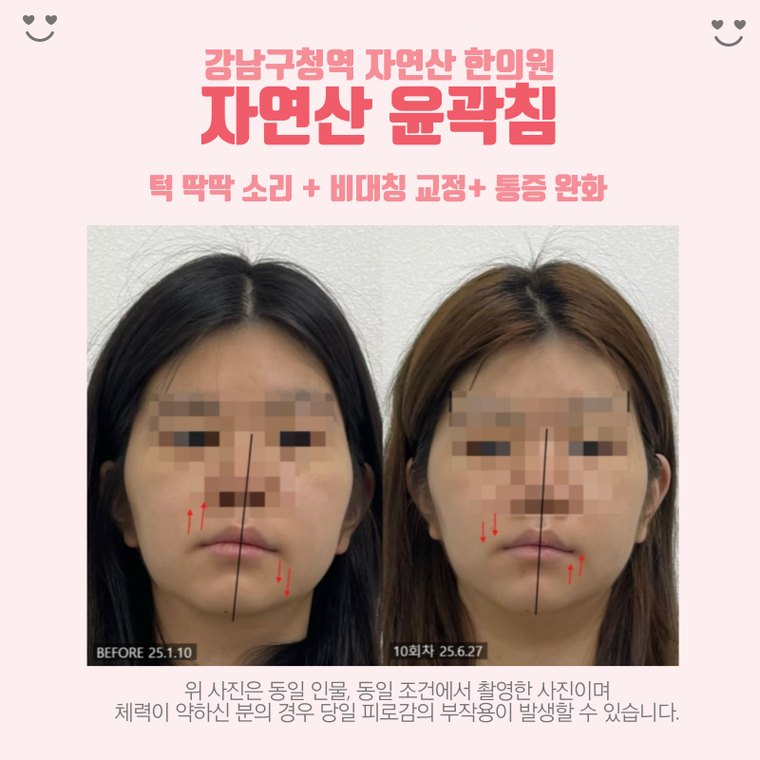 jaw-clicking-sound 치료 사례 5 — 시술 전후 비교