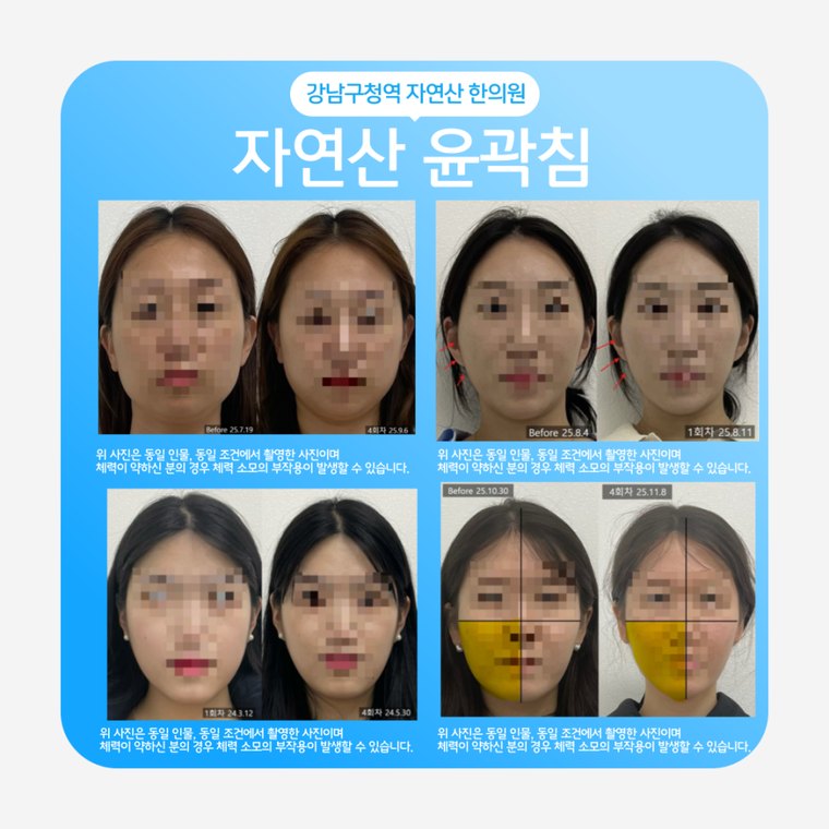 jaw-muscle-asymmetry 치료 사례 1 — 시술 전후 비교