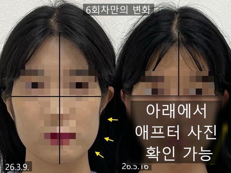 jaw-muscle-imbalance 치료 사례 1 — 시술 전후 비교