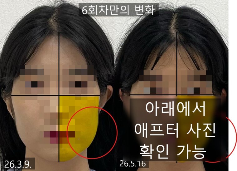 jaw-muscle-imbalance 치료 사례 2 — 시술 전후 비교
