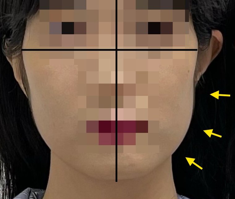 jaw-muscle-imbalance 치료 사례 3 — 시술 전후 비교