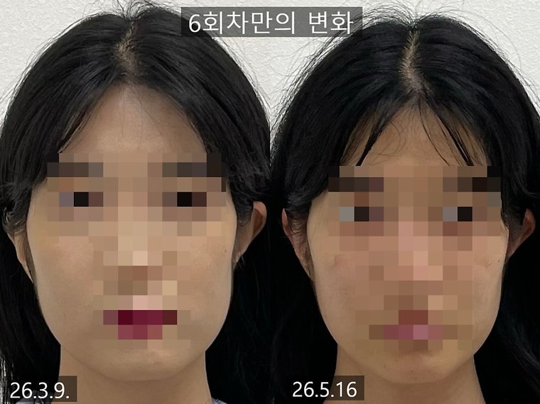 jaw-muscle-imbalance 치료 사례 4 — 시술 전후 비교