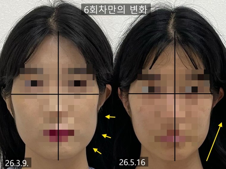 jaw-muscle-imbalance 치료 사례 5 — 시술 전후 비교