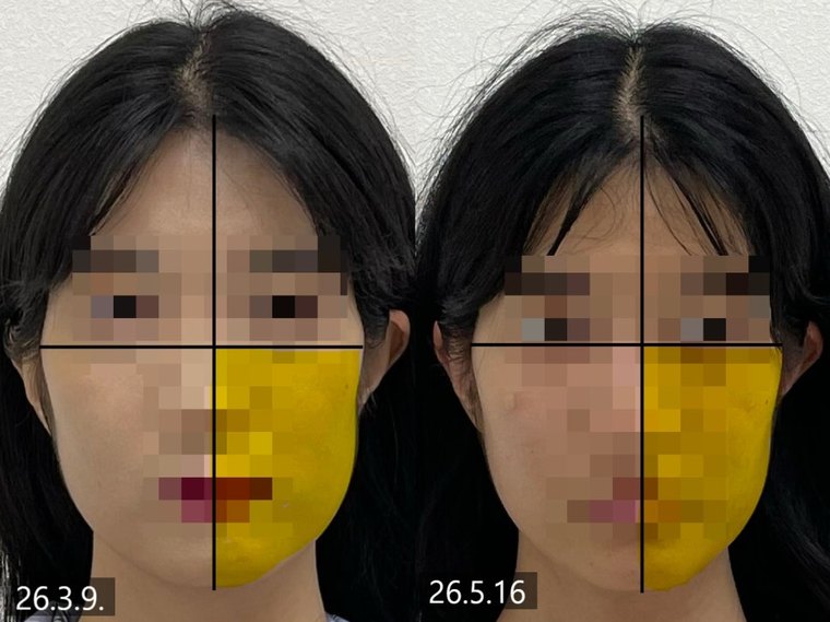 jaw-muscle-imbalance 치료 사례 6 — 시술 전후 비교