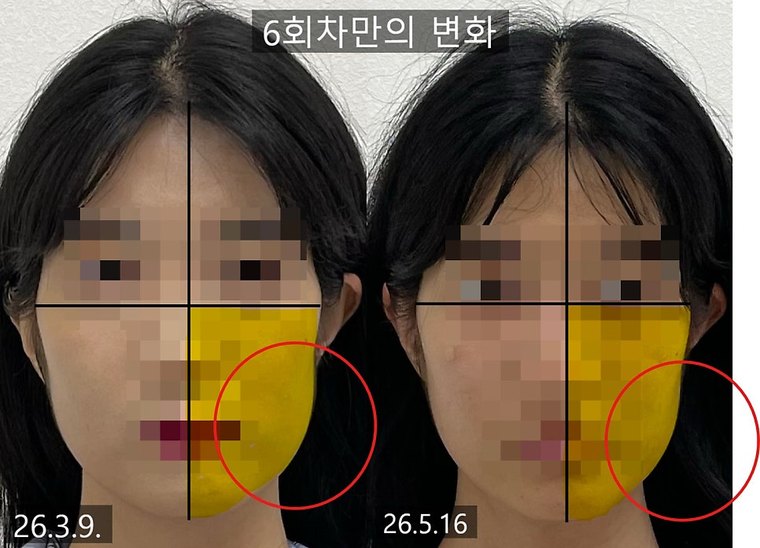jaw-muscle-imbalance 치료 사례 7 — 시술 전후 비교