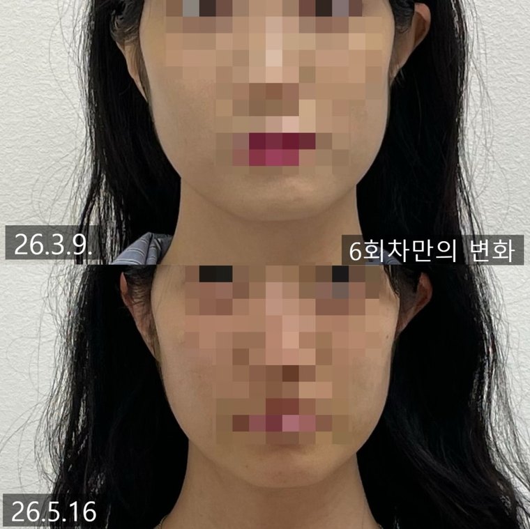 jaw-muscle-imbalance 치료 사례 8 — 시술 전후 비교