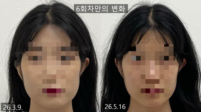 jaw-muscle-imbalance 치료 사례 9 — 시술 전후 비교