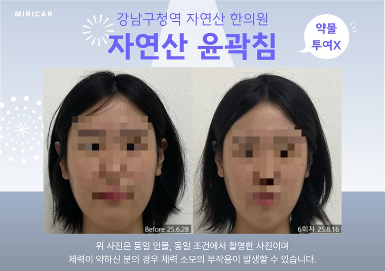 jaw-muscle-knot 치료 사례 1 — 시술 전후 비교