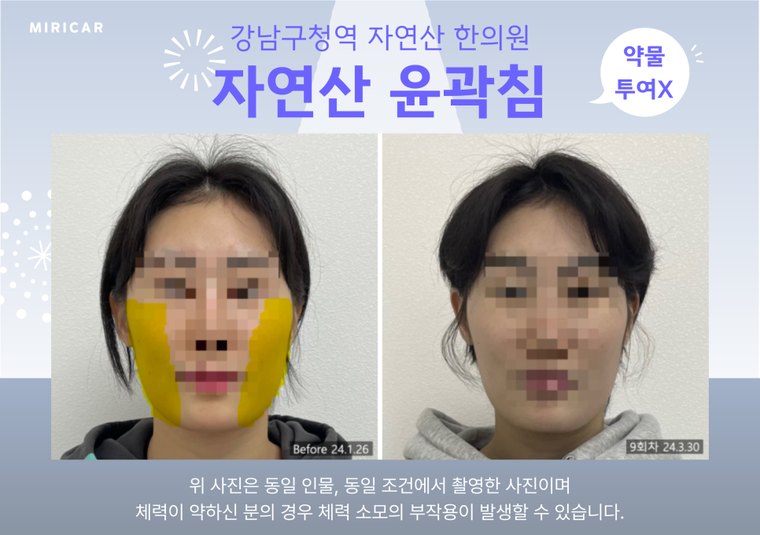jaw-muscle-knot 치료 사례 2 — 시술 전후 비교