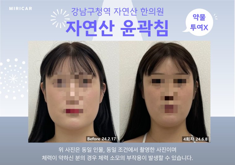 jaw-muscle-knot 치료 사례 3 — 시술 전후 비교