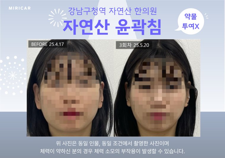 jaw-muscle-knot 치료 사례 4 — 시술 전후 비교