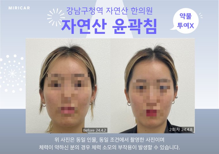 jaw-muscle-knot 치료 사례 5 — 시술 전후 비교