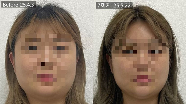 jaw-muscle-pain 치료 사례 1 — 시술 전후 비교