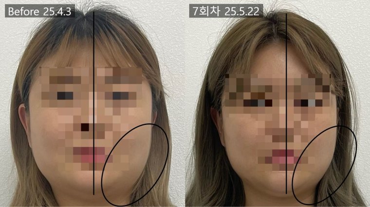 jaw-muscle-pain 치료 사례 2 — 시술 전후 비교