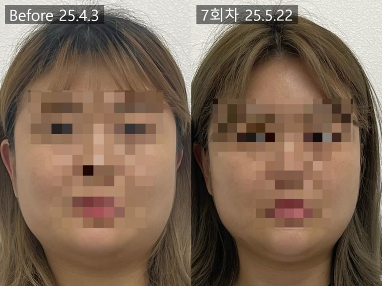 jaw-muscle-pain 치료 사례 3 — 시술 전후 비교