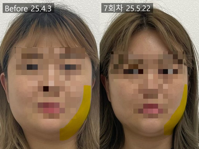 jaw-muscle-pain 치료 사례 4 — 시술 전후 비교