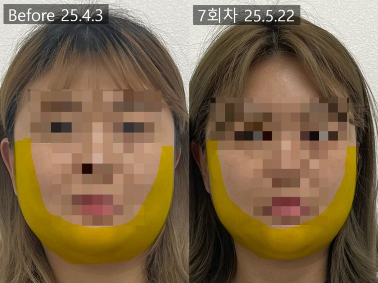 jaw-muscle-pain 치료 사례 6 — 시술 전후 비교