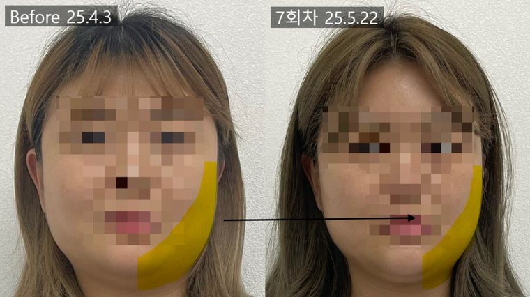 jaw-muscle-pain 치료 사례 7 — 시술 전후 비교