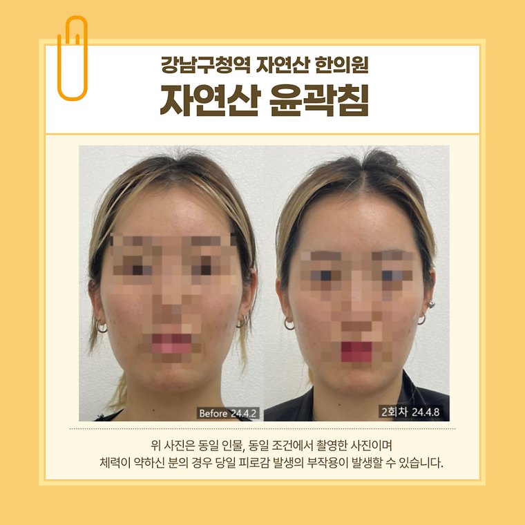 jaw-muscle-reduction 치료 사례 1 — 시술 전후 비교