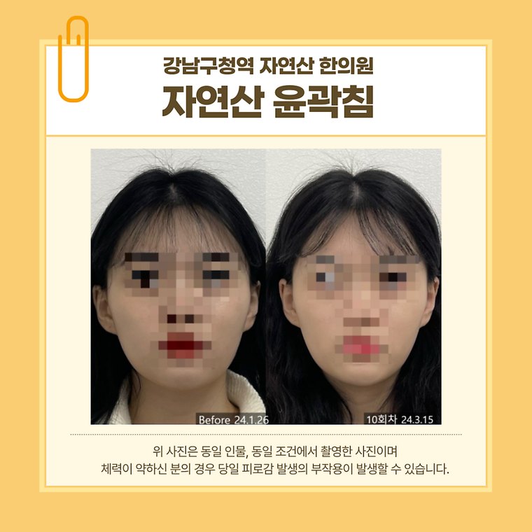 jaw-muscle-reduction 치료 사례 2 — 시술 전후 비교